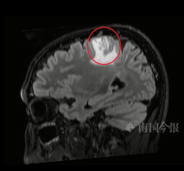 不要吃！不要吃！广西男子脑中揪出5厘米长虫！医生紧急提醒