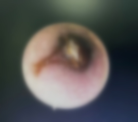 头皮发麻！一男子半夜耳痛，耳道内挖出整只蟑螂……