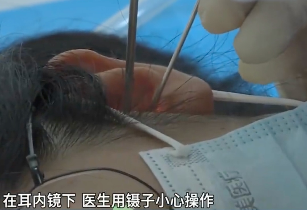 头皮发麻！一男子半夜耳痛，耳道内挖出整只蟑螂……