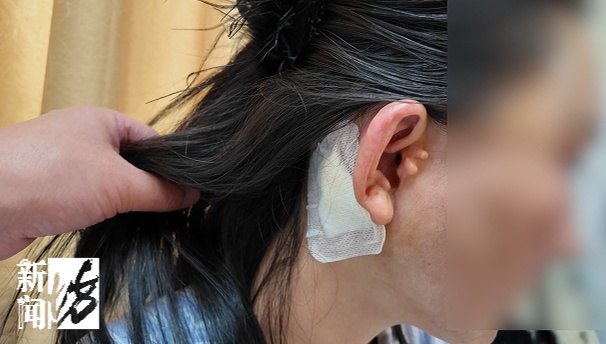 女子嫌耳朵不够美，跟风改造竟致“眼歪嘴斜”：喝水吃饭都漏