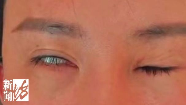 女子嫌耳朵不够美，跟风改造竟致“眼歪嘴斜”：喝水吃饭都漏