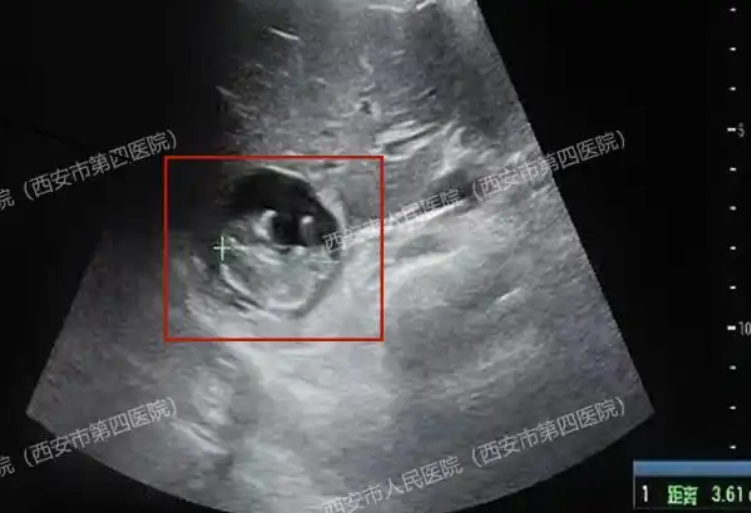 极其罕见！女子怀孕后检查发现，子宫内不见胎儿？
