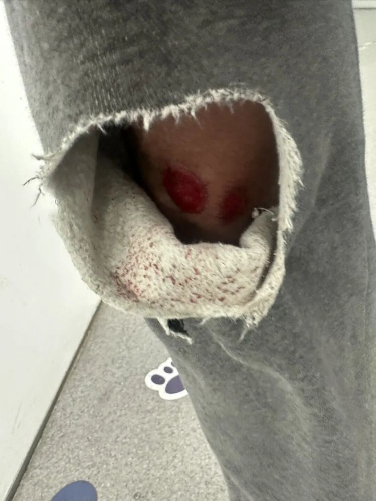 “波棱盖子咔马路牙子上磕秃噜皮,裤子也咔坏了!” “波棱盖子咔马路牙子上磕秃噜皮,裤子也咔坏了!”