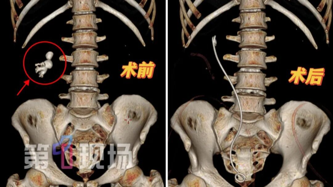 3年养出肾脏“珊瑚迷宫”38岁男子突然腰痛如遇酷刑，医生检查发现…