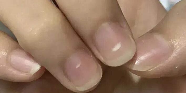 指甲暗藏健康危机！这一点最易被忽视，快自查→