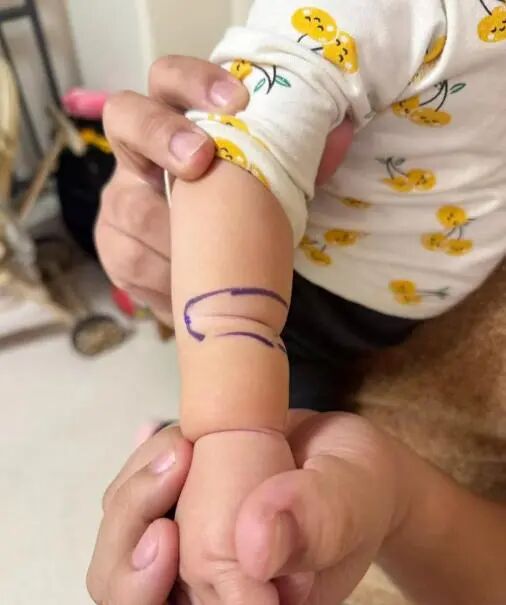 孩子身上出现“莲藕纹”?小心束带综合征 孩子身上出现“莲藕纹”?小心束带综合征