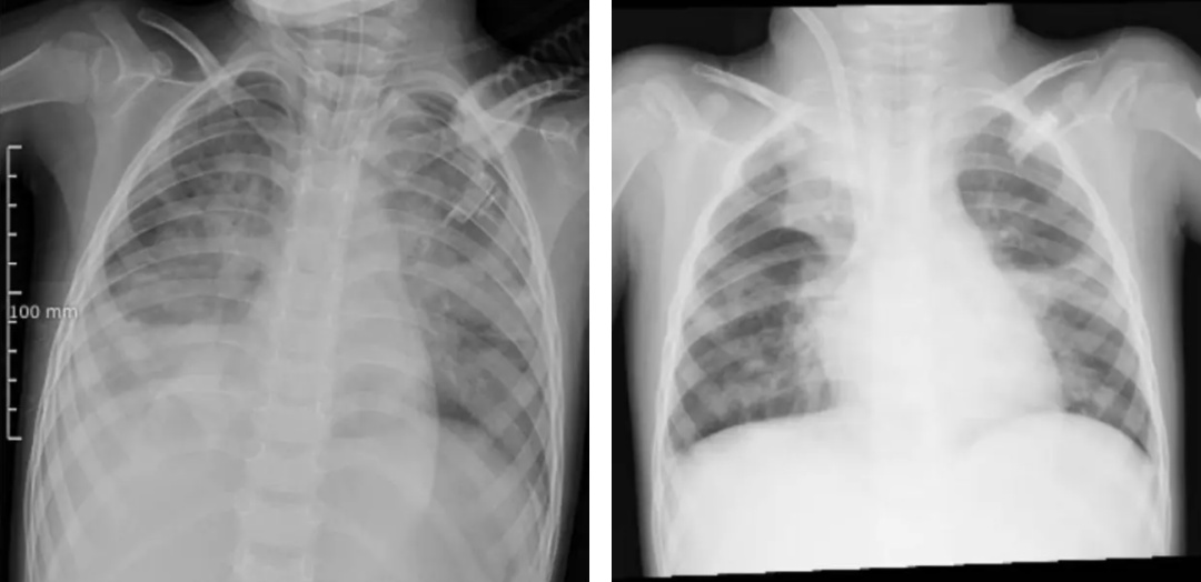 4岁女童持续发烧！不到24小时肺都白了，有这些症状立即就医