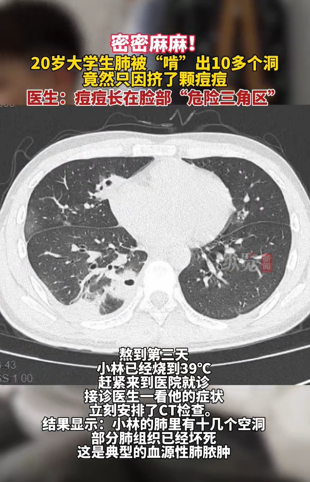 一颗痘竟让肺“千疮百孔”？真的别随便挤了，严重可危及生命！