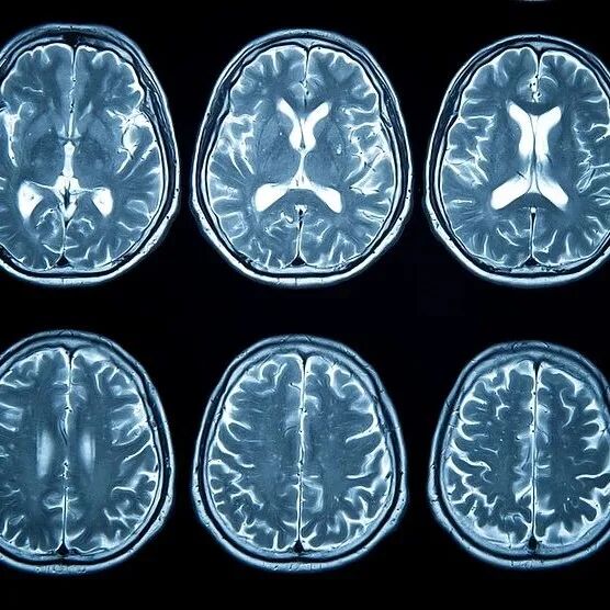 睡前有这 5 种表现，可能是脑梗！