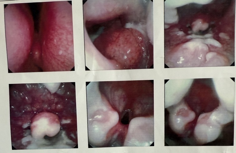 奶奶让6岁孙女猛吸蒸汽“治咳嗽”，导致咽喉烫伤溃疡