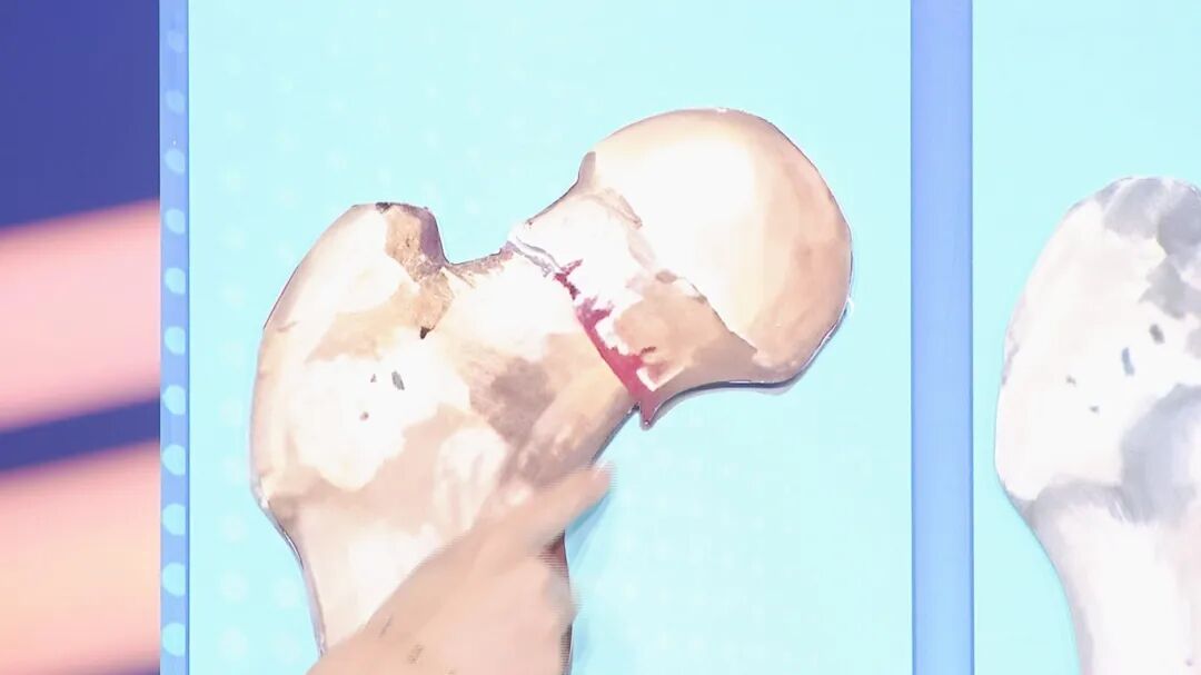 北京暴雪+道路结冰双预警！雪天路滑，警惕这种骨折，拍片子可能都看不出来→