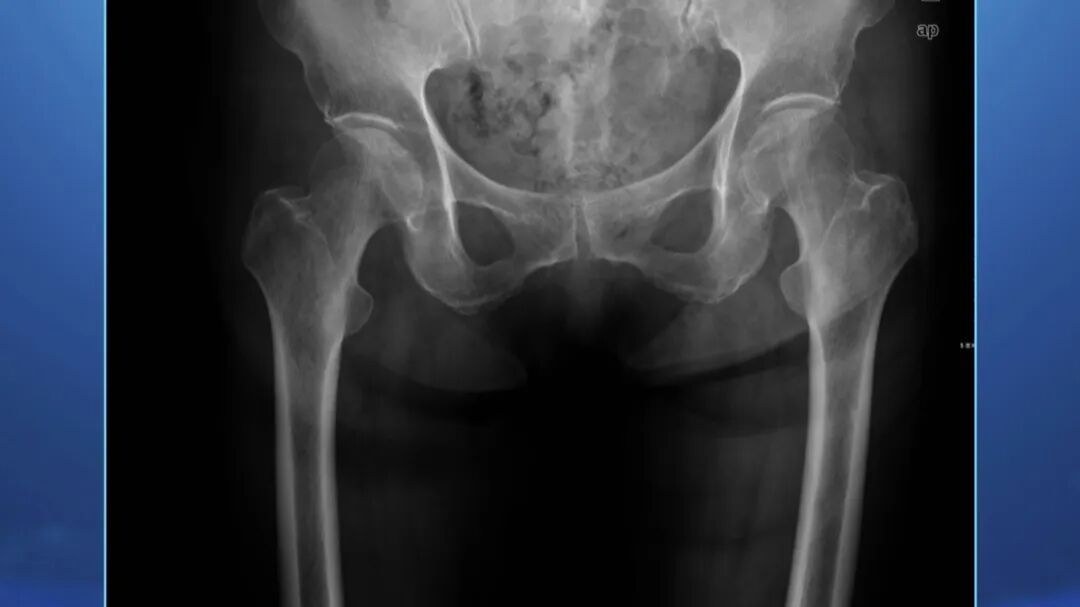 北京暴雪+道路结冰双预警！雪天路滑，警惕这种骨折，拍片子可能都看不出来→