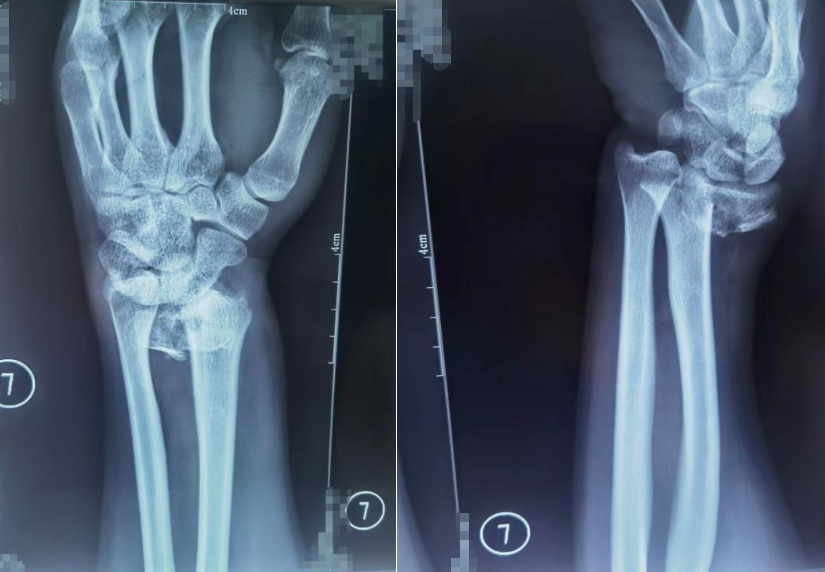 降雪后，今天别走这种路面！医生紧急提醒——