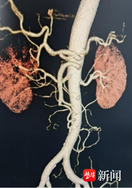 老奶奶腹痛后肠道中风了 老奶奶腹痛后肠道中风了