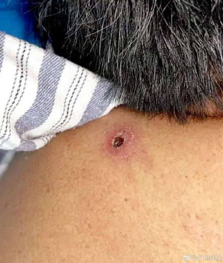 农妇突然病危 原来病因藏在肩上焦痂 农妇突然病危 原来病因藏在肩上焦痂