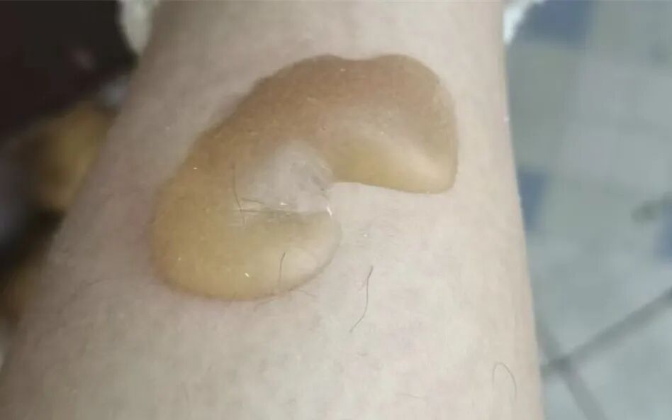 不知不觉烫掉一层皮,当心取暖“神器”变“凶器” 不知不觉烫掉一层皮,当心取暖“神器”变“凶器”