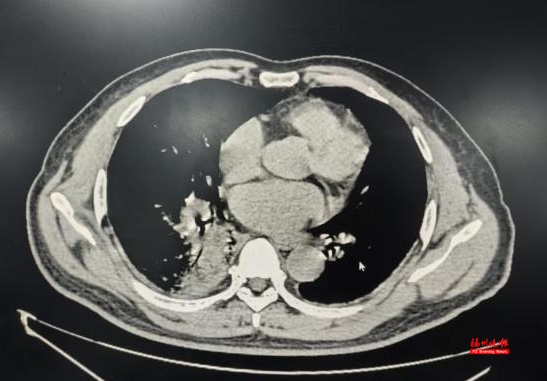 “家里养了一些鸡鸭，怎么得了肺炎？”