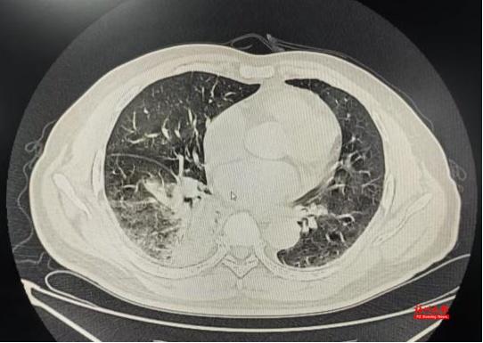 “家里养了一些鸡鸭，怎么得了肺炎？”