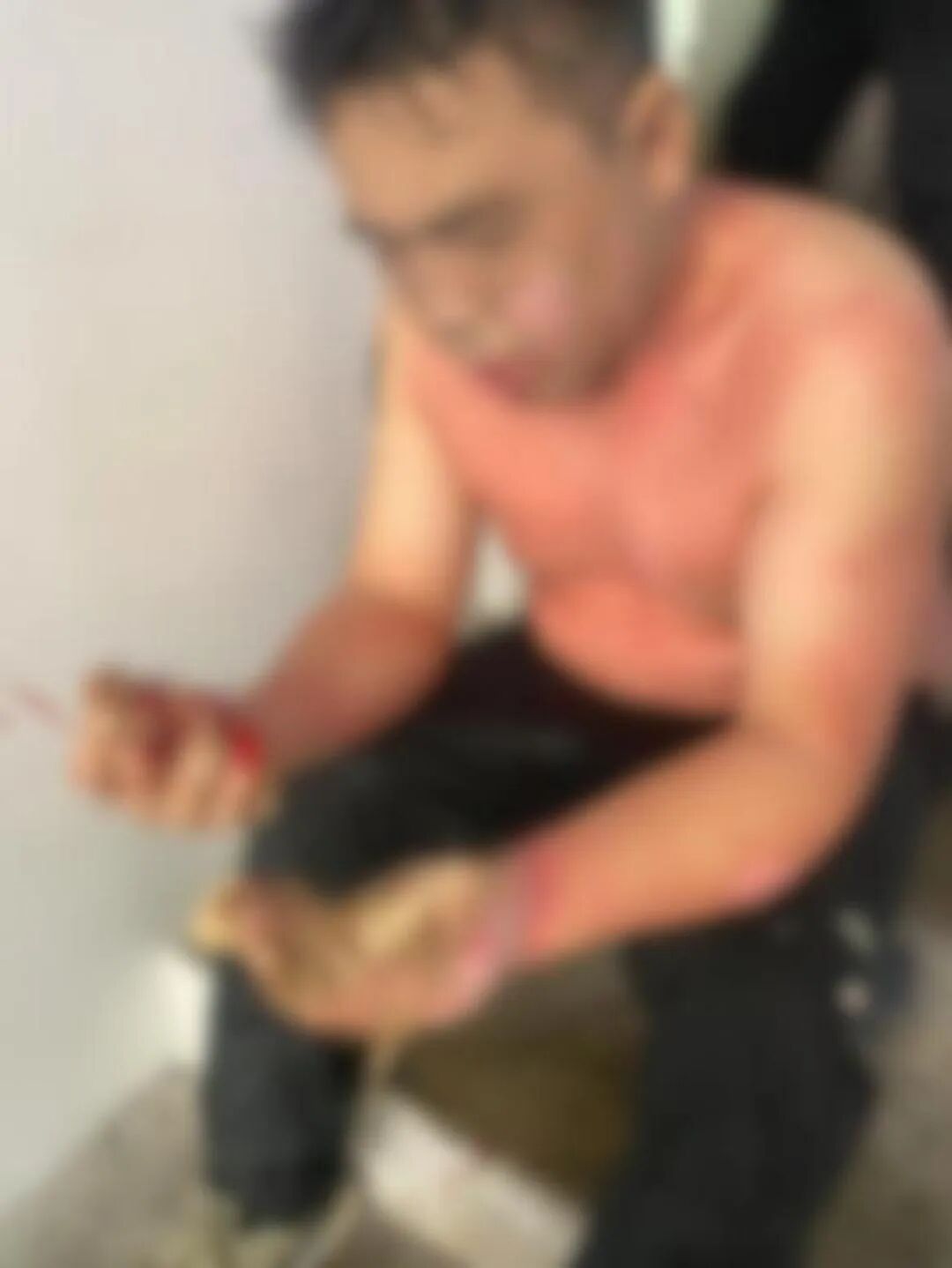 全身大面积烧伤烫伤,还有感染、肾损伤……今晚洗澡前快检查! 全身大面积烧伤烫伤,还有感染、肾损伤……今晚洗澡前快检查!