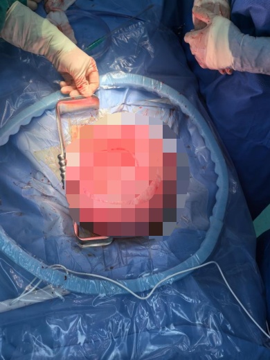 拖了10年,52岁女子体内肌瘤长到近30厘米!“还以为只是中年发福了” 拖了10年,52岁女子体内肌瘤长到近30厘米!“还以为只是中年发福了”