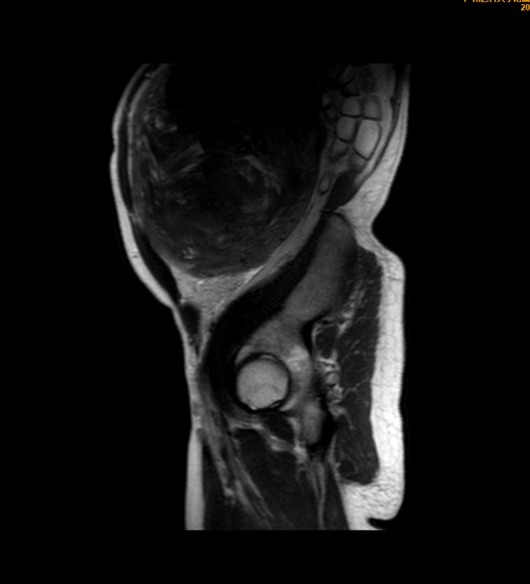 拖了10年,52岁女子体内肌瘤长到近30厘米!“还以为只是中年发福了” 拖了10年,52岁女子体内肌瘤长到近30厘米!“还以为只是中年发福了”