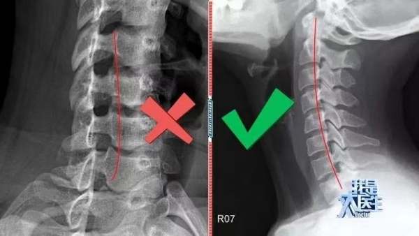 记住这个动作,颈椎回归“C位” 记住这个动作,颈椎回归“C位”