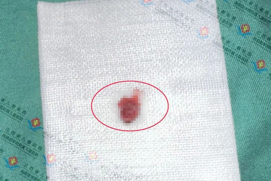 10岁男童性早熟,竟是这个原因 10岁男童性早熟,竟是这个原因