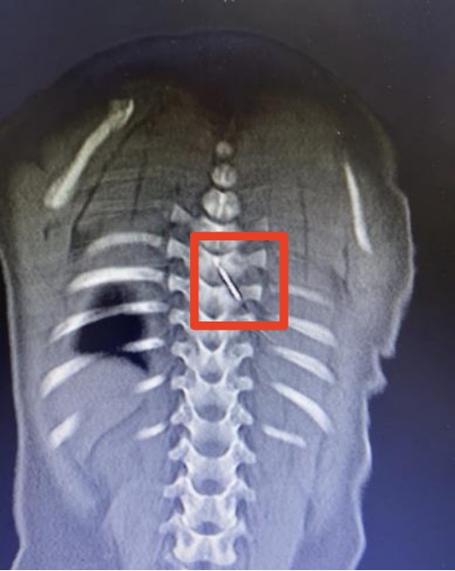 惊险！约3厘米长缝衣针裹被子里，扎入9月龄宝宝脊柱 ，医生：针的位置极其刁钻