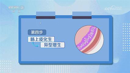 感染“幽门螺杆菌”到“胃癌”只有5步 预防这样做→