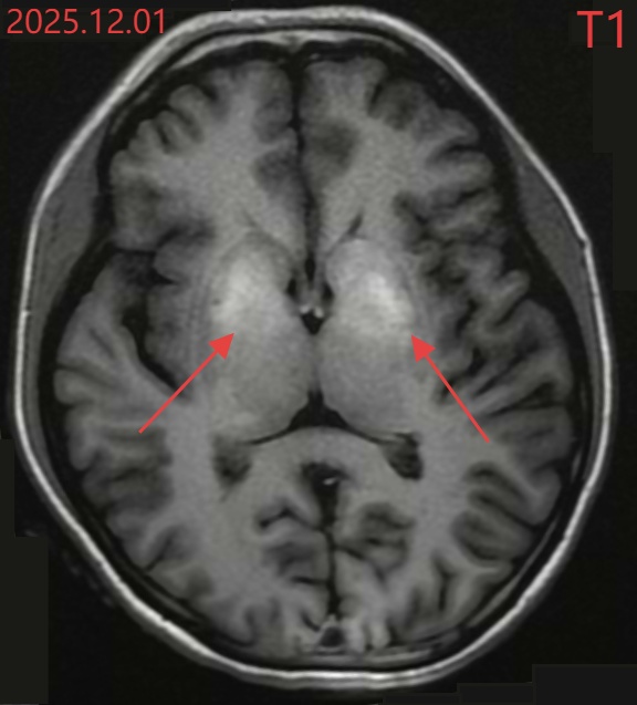 无法自控！20岁女孩突发“舞蹈病”