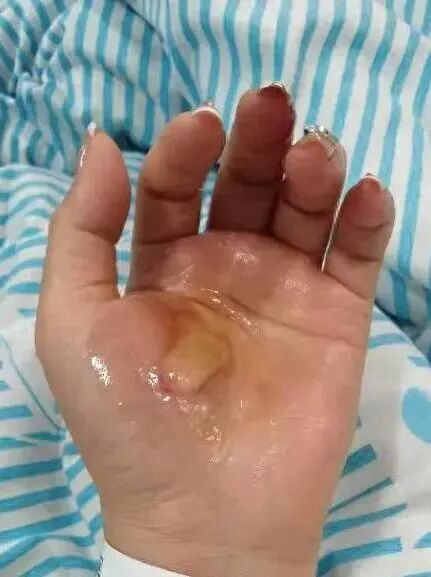 突然爆炸,全身大面积烫伤,警惕热水器三大风险! 突然爆炸,全身大面积烫伤,警惕热水器三大风险!