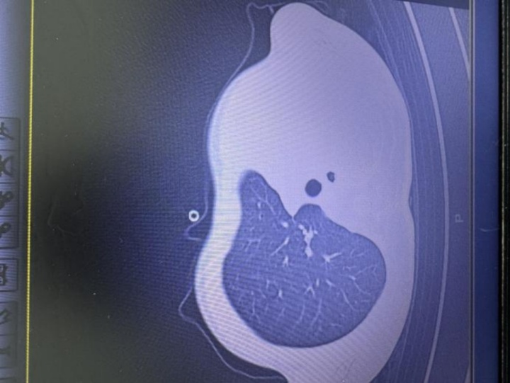 早上发烧,晚上就“白肺”!连续两年因流感进ICU!肺里长出这种“死亡树杈” 早上发烧,晚上就“白肺”!连续两年因流感进ICU!肺里长出这种“死亡树杈”