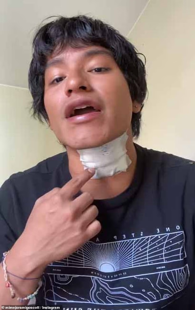 秘鲁21岁歌手被麦克风电击倒地,现场火花四溅,此次电击造成他颈部烧伤 秘鲁21岁歌手被麦克风电击倒地,现场火花四溅,此次电击造成他颈部烧伤