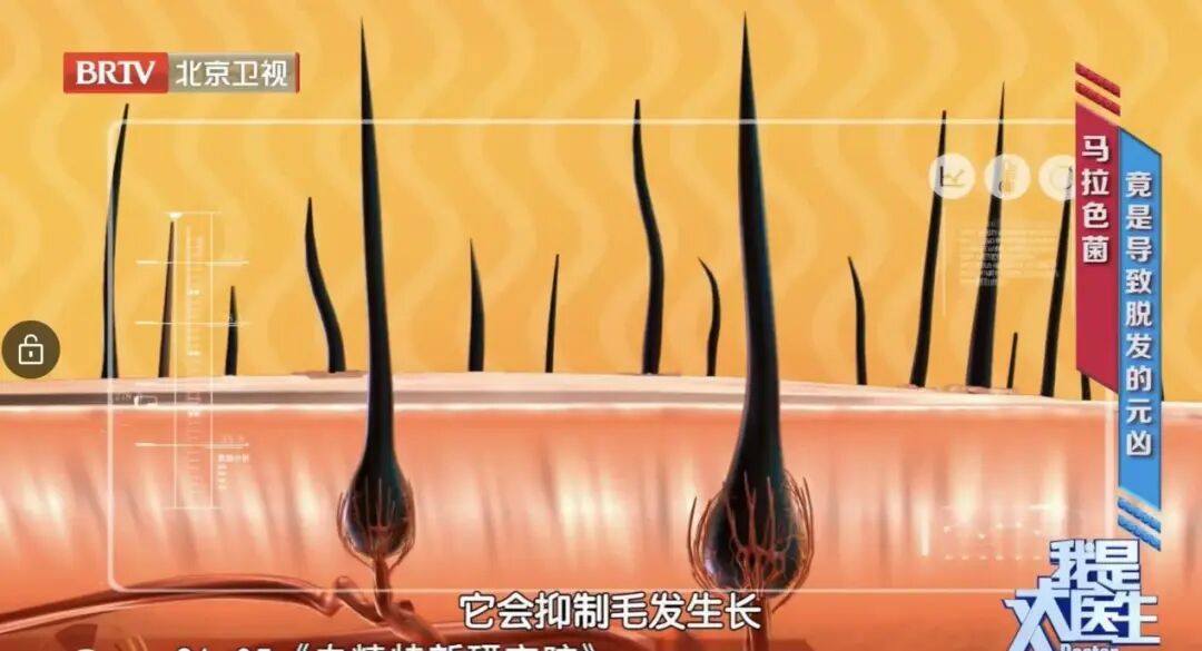 戴帽子或造成脱发?注意这几点 戴帽子或造成脱发?注意这几点