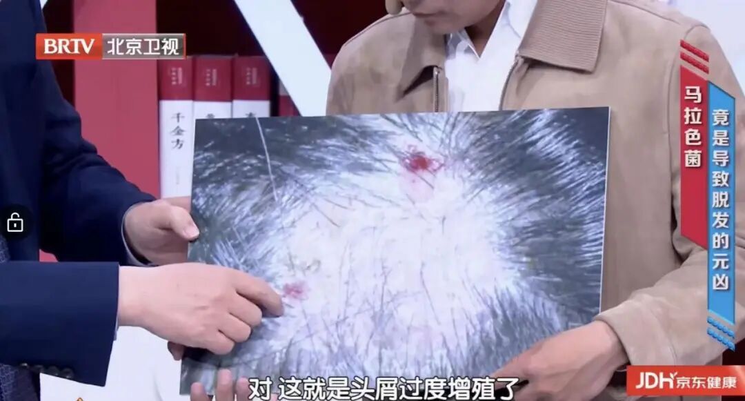 戴帽子或造成脱发?注意这几点 戴帽子或造成脱发?注意这几点