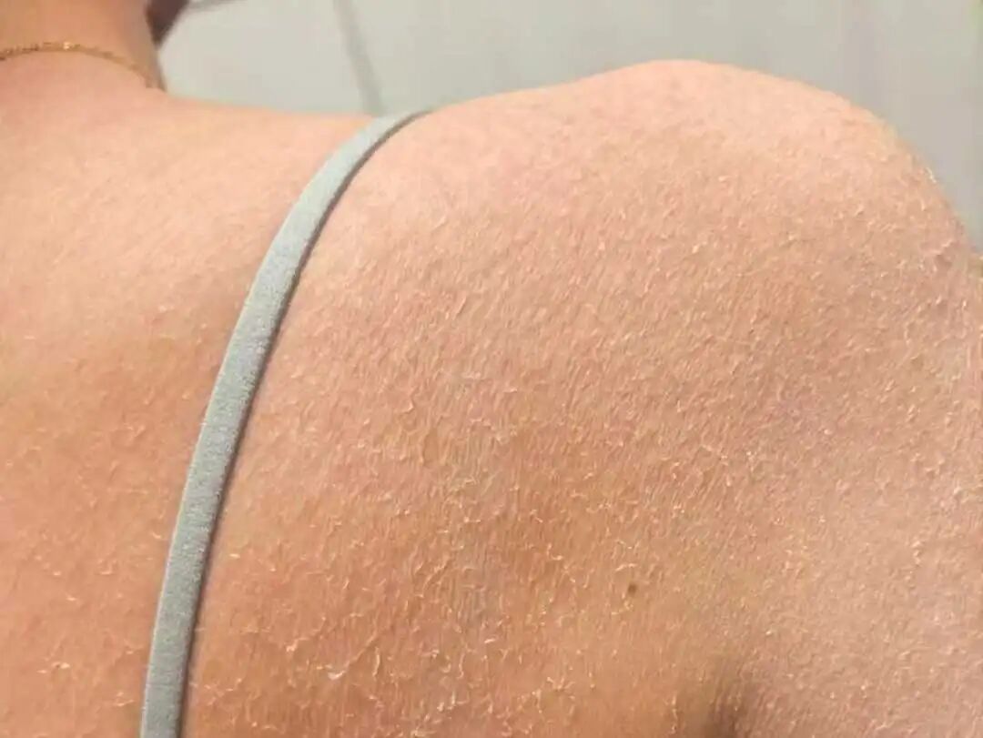 “腿上像糊了鱼鳞，晚上痒得钻心！”降温后多人中招，医生提醒