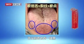 舌头是胃部 “直播屏”，40岁以上必看