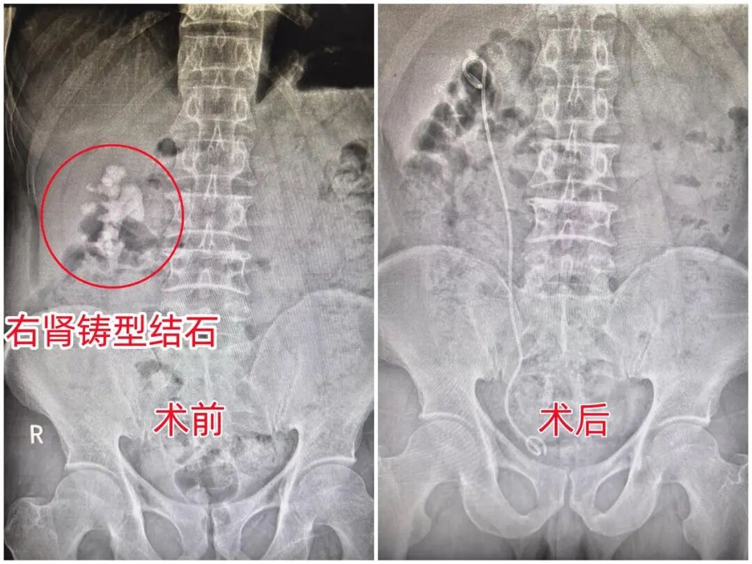 五旬男子干完体力活就腰胀，原是右肾被结石填满