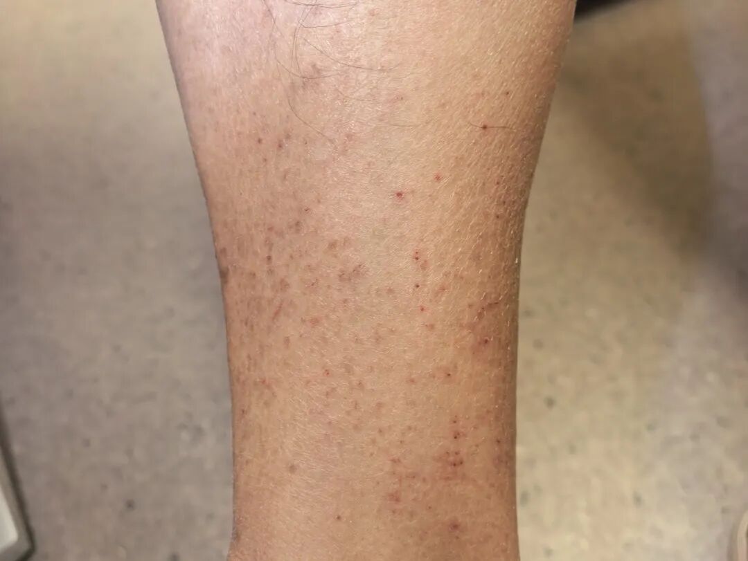 “腿上像糊了鱼鳞，晚上痒得钻心！”降温后多人中招，医生提醒