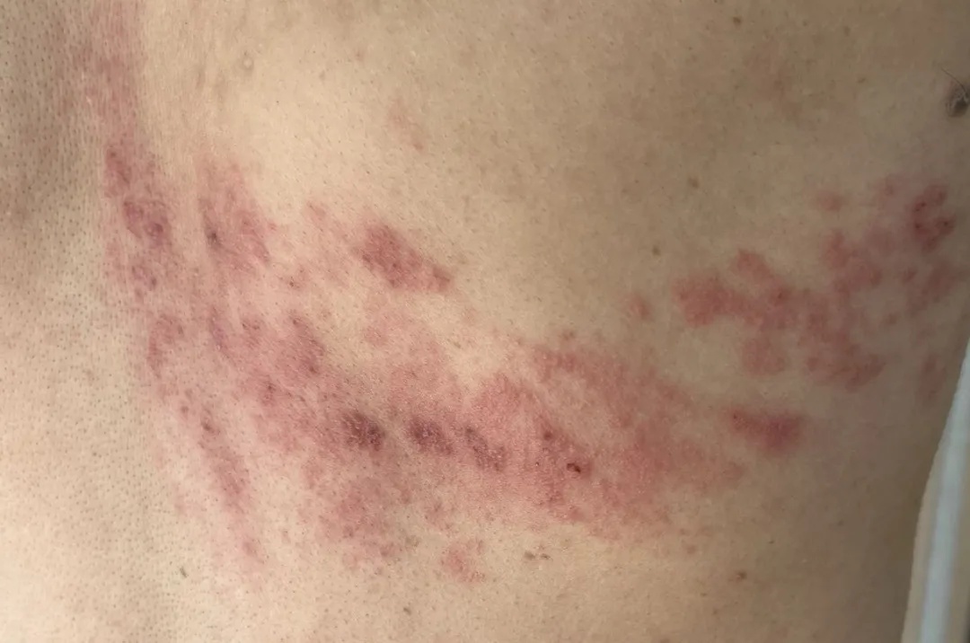 每年冬天杭州都有不少人中招，剧痛难忍......尽早去正规医院！