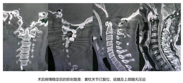 惊心动魄！60岁老人因意外“头颈分离”直送ICU