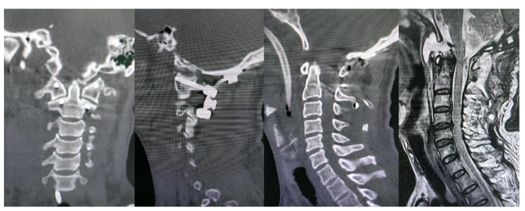 广州老伯意外“头颈分离”，医生用妙招果断救回