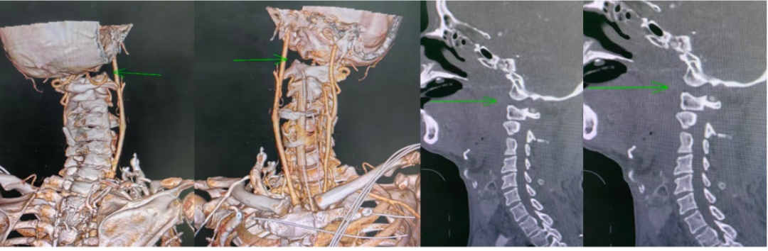 广州老伯意外“头颈分离”，医生用妙招果断救回