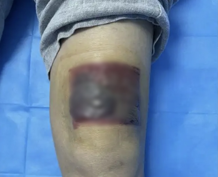 连贴三晚，男子膝盖深Ⅲ度烫伤！很多人冬天都用它……