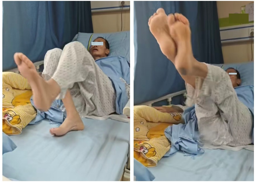 广州老伯意外“头颈分离”，医生用妙招果断救回