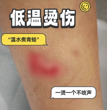 连贴三晚，男子膝盖深Ⅲ度烫伤！很多人冬天都用它……