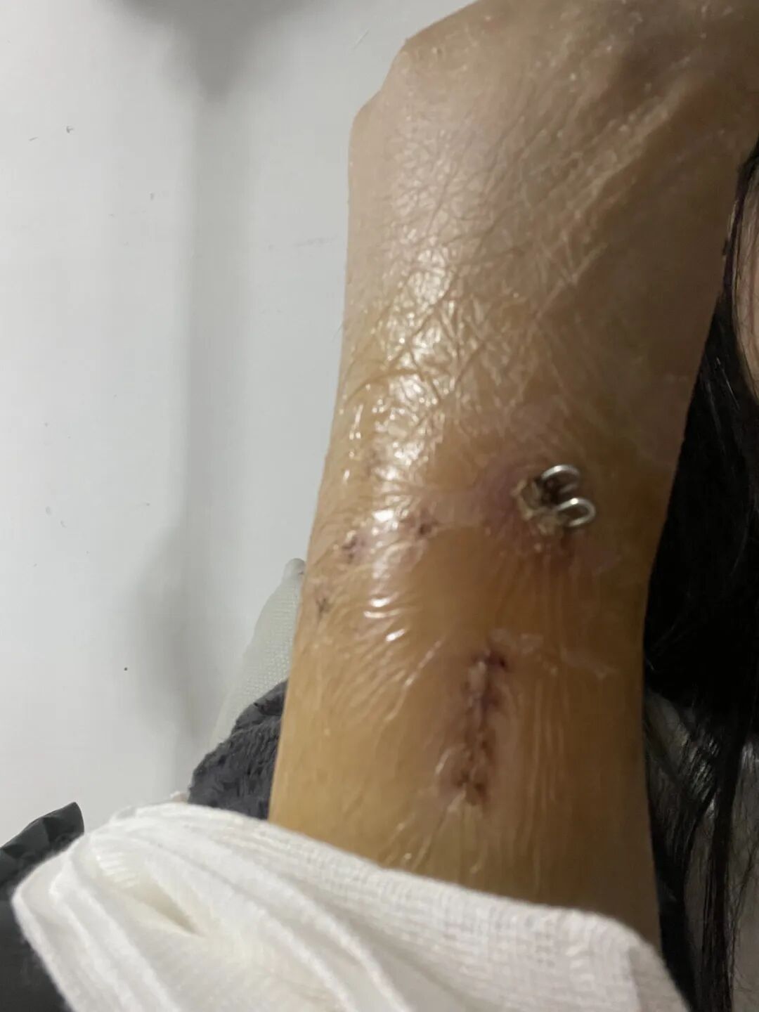 事发陆家嘴天桥！上海阿姨摔惨了，桡骨骨折，缝了26针！网友：下雨天这里总有人滑倒