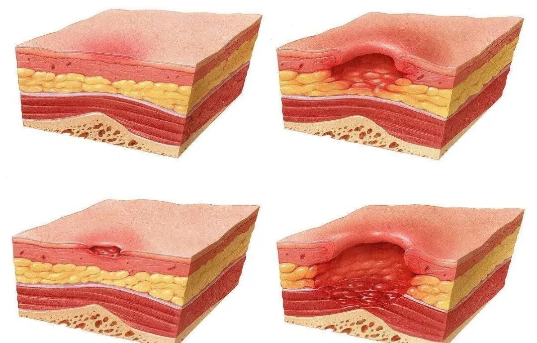 开一夜，21岁女生一觉醒来得了褥疮！这件事不能超6小时，严重或危及生命
