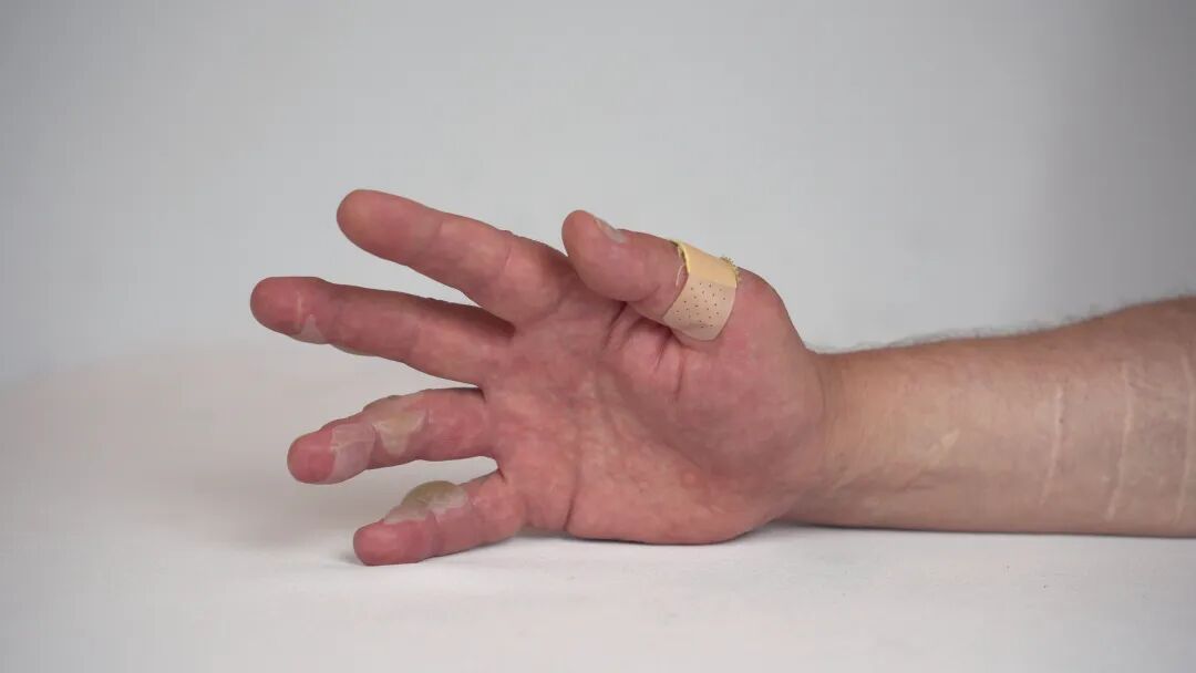 有人屁股差点“报废”，有人被截趾！医生提醒：这些冬日“神器”有危险！