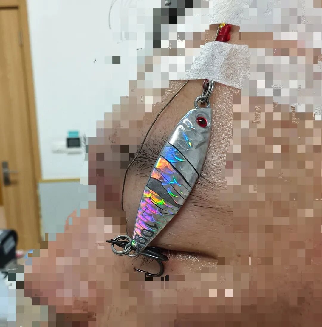 “偷袭”成功！它深深刺入左眼球，将男子送进医院